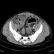 Crohn's disease, rupture of ileum, peritonitis: CT - Computed tomography